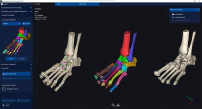 3D models of the foot and ankle generated in Bonelogic medical imaging software