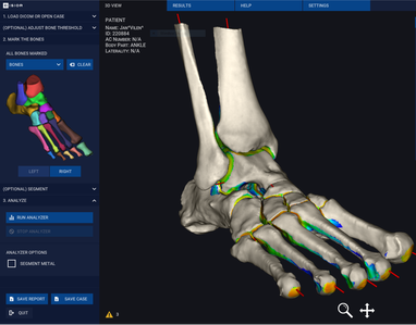 3D model of a whole foot from a WBCT scan, showing joint space mapping