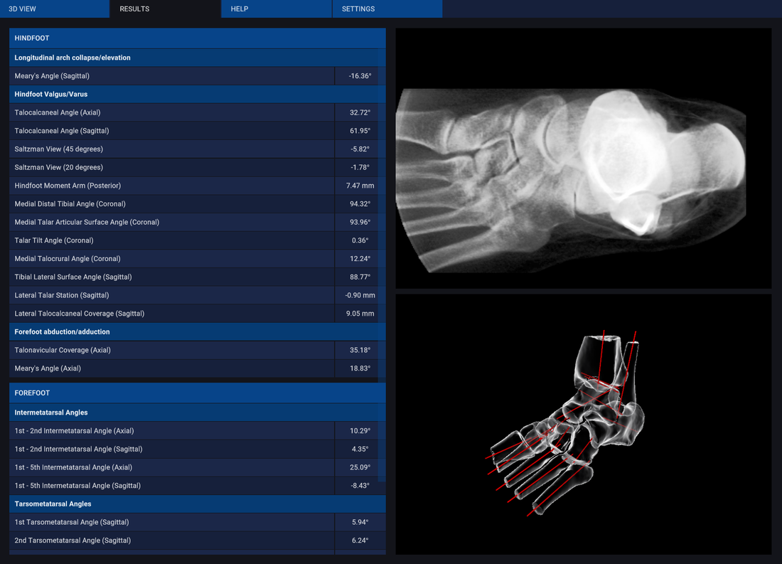 Automated 3D analytics of the foot with digitally reconstructed radiograph 