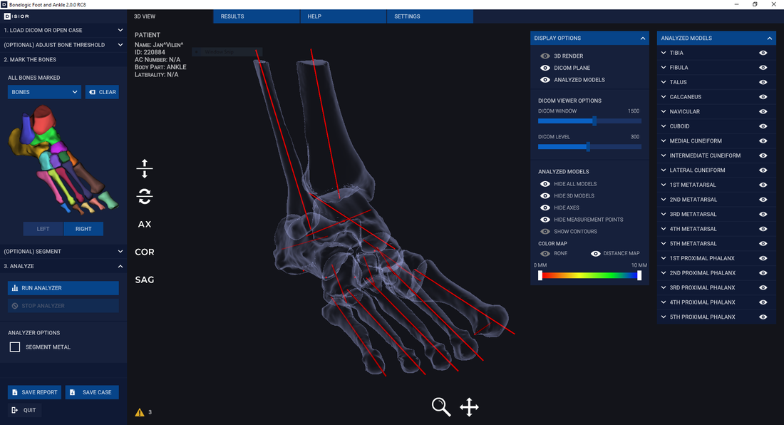 3D analysis of a whole foot from Bonelogic medical imaging software